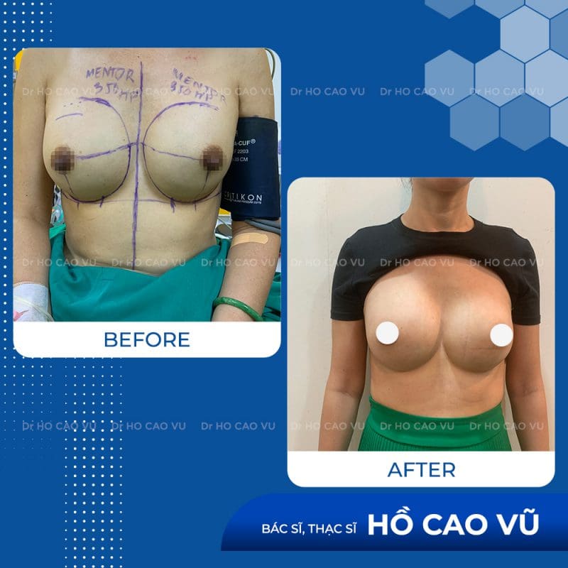 Nguy cơ tái phát cao sau phẫu thuật bóc bao xơ đặt lại túi.