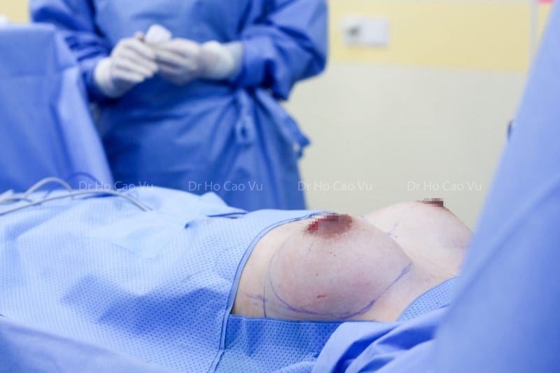 augmentation-surgery