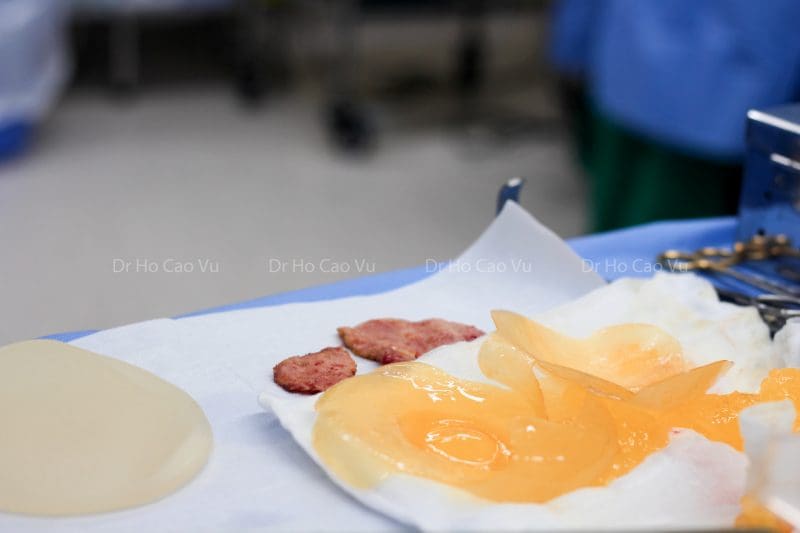 augmentation-surgery