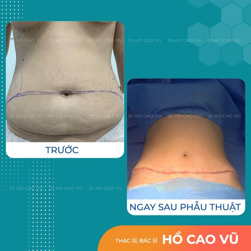 tao-hinh-thanh-bung-2