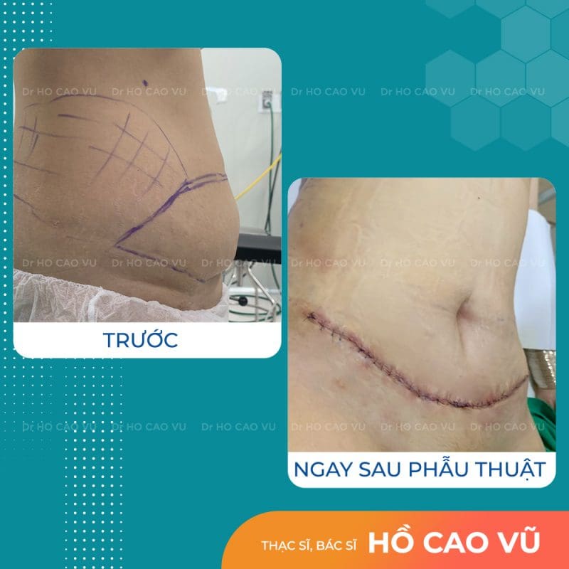 tao-hinh-thanh-bung-23