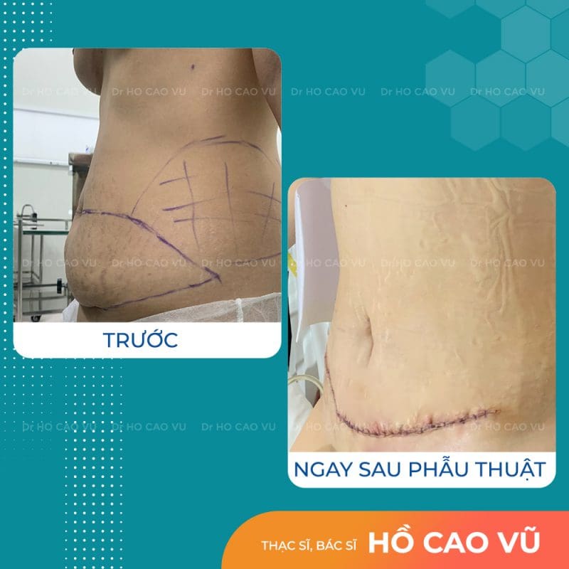 tao-hinh-thanh-bung-3