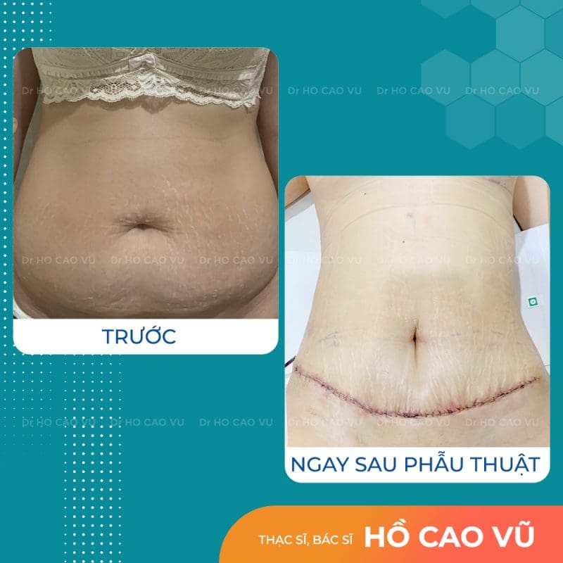 tao-hinh-thanh-bung-22