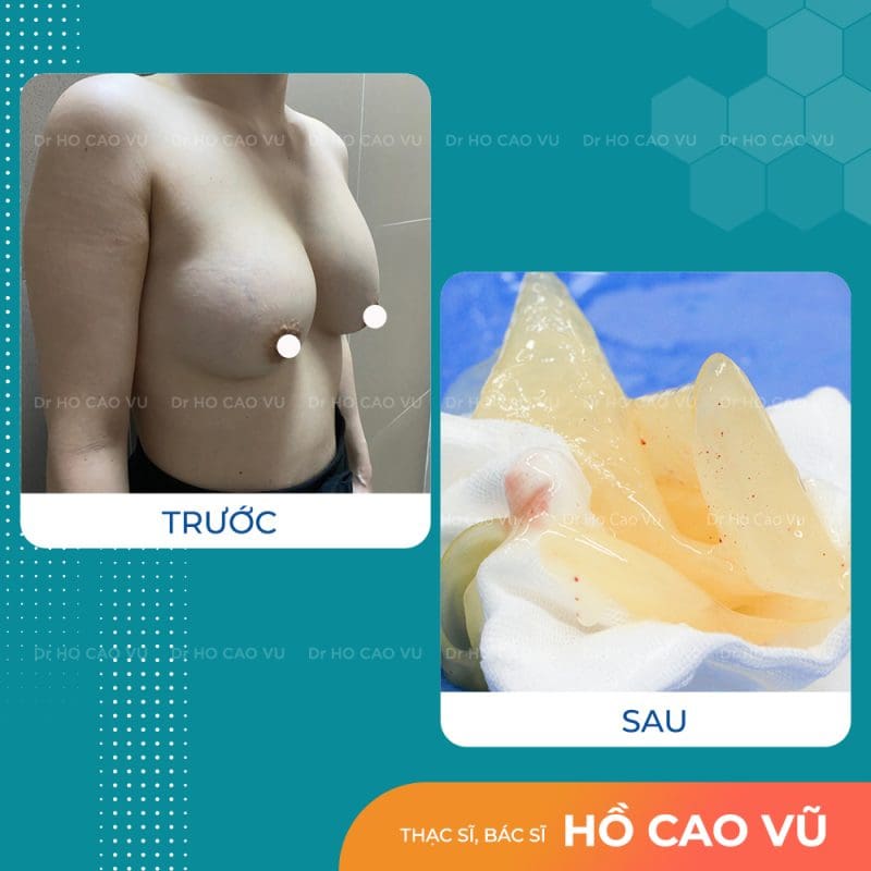 tui-nguc-vo-2