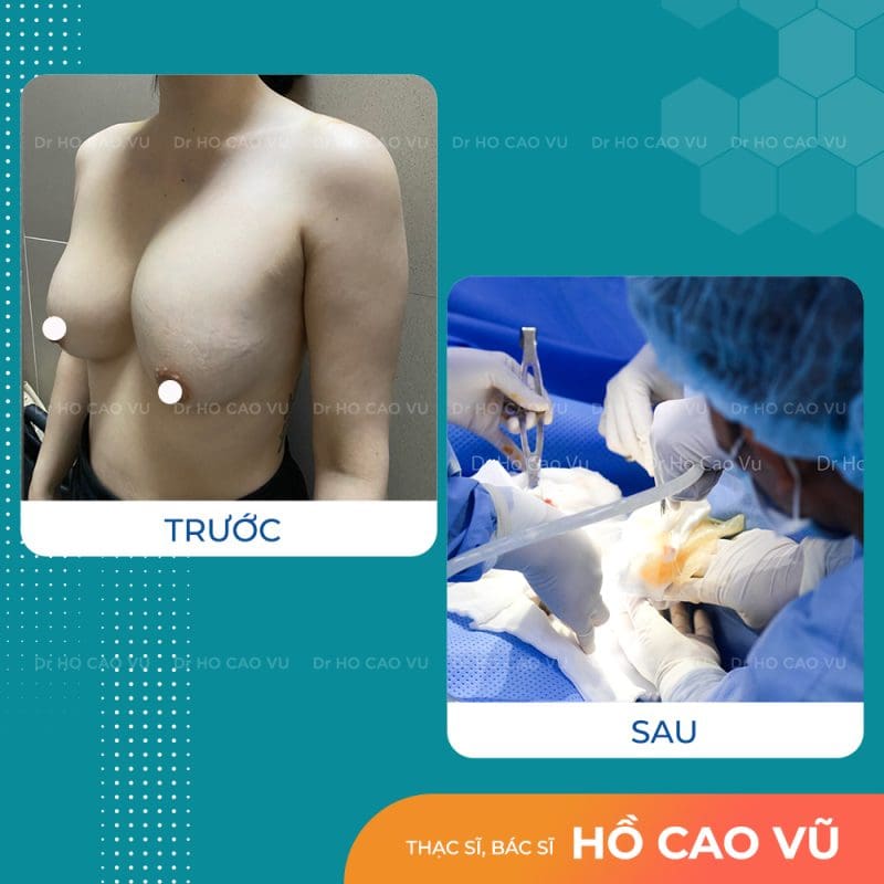 tui-nguc-vo-3