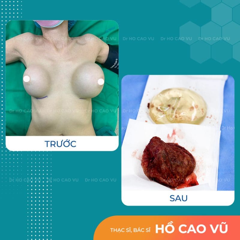 phau-thuat-thao-tui-nguc-92