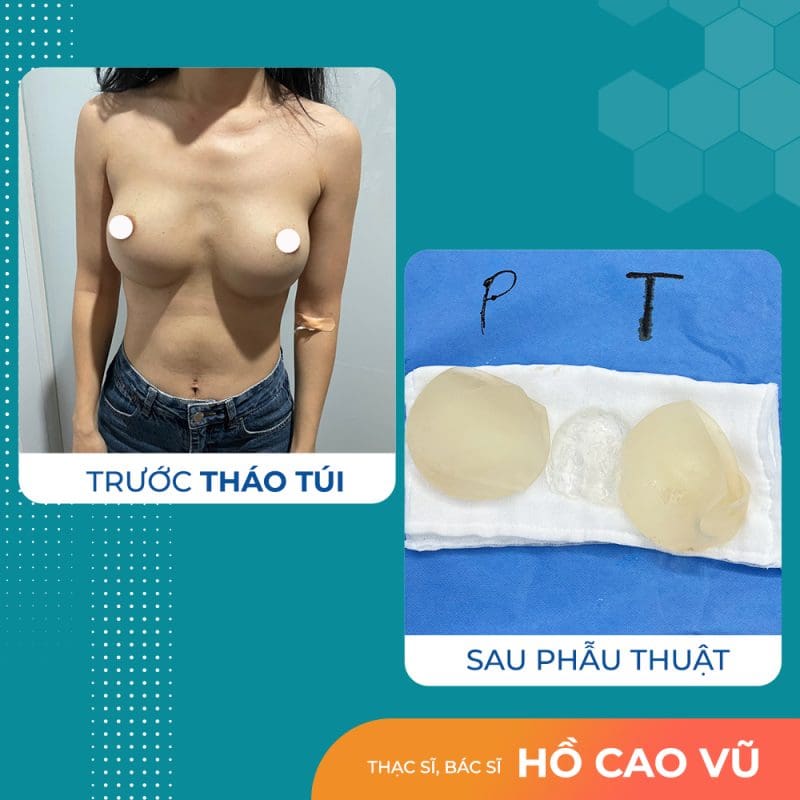 tran thi kim loan thao tui