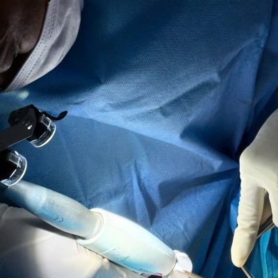 Dissection into the subpectoral pocket using the Ultrasonic Surgical Scalpel