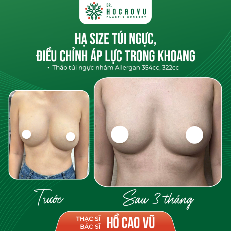 Hình ảnh sau 3 tháng tháo túi hạ sai điều chỉnh áp lực khoang ngực trái 