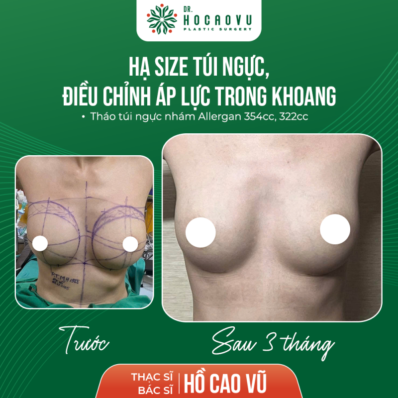 Hình ảnh sau 3 tháng tháo túi hạ sai điều chỉnh áp lực khoang ngực trái 
