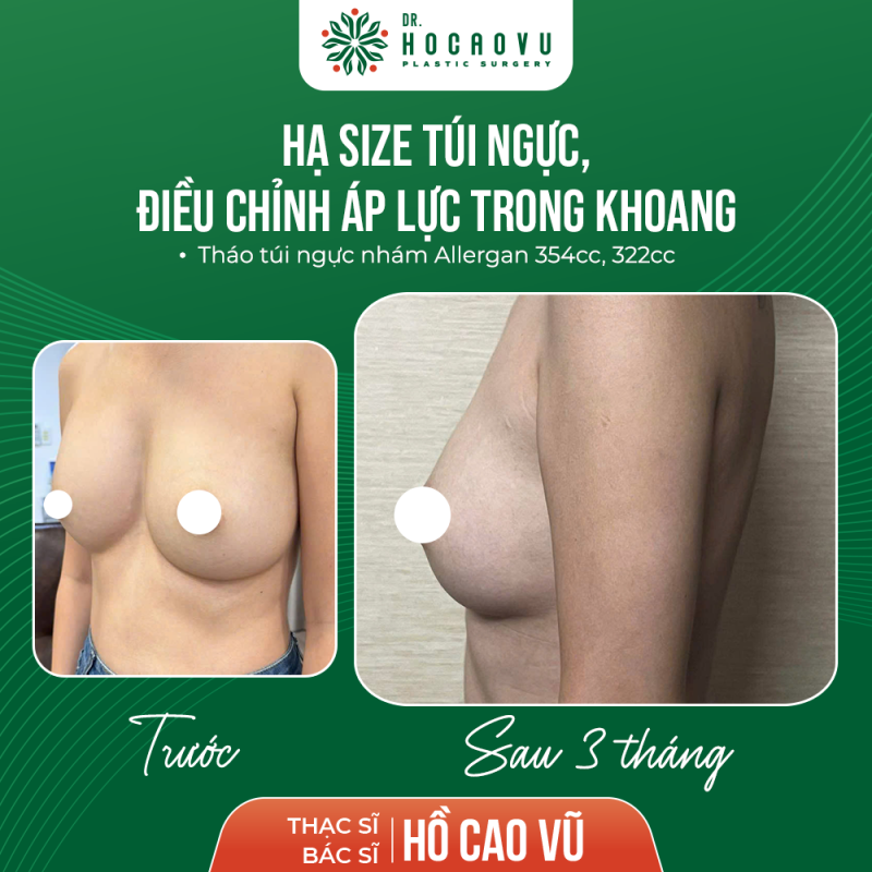 Hình ảnh sau 3 tháng tháo túi hạ sai điều chỉnh áp lực khoang ngực trái 