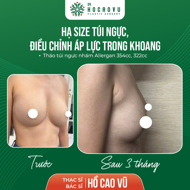 Hình ảnh sau 3 tháng tháo túi hạ sai điều chỉnh áp lực khoang ngực trái 