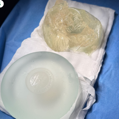 Hình ảnh tháo túi ngực vỡ