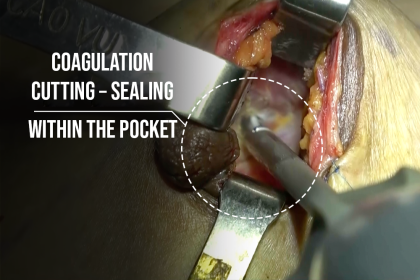 Coagulation, sealing, and cutting of blood vessels within the implant pocket
