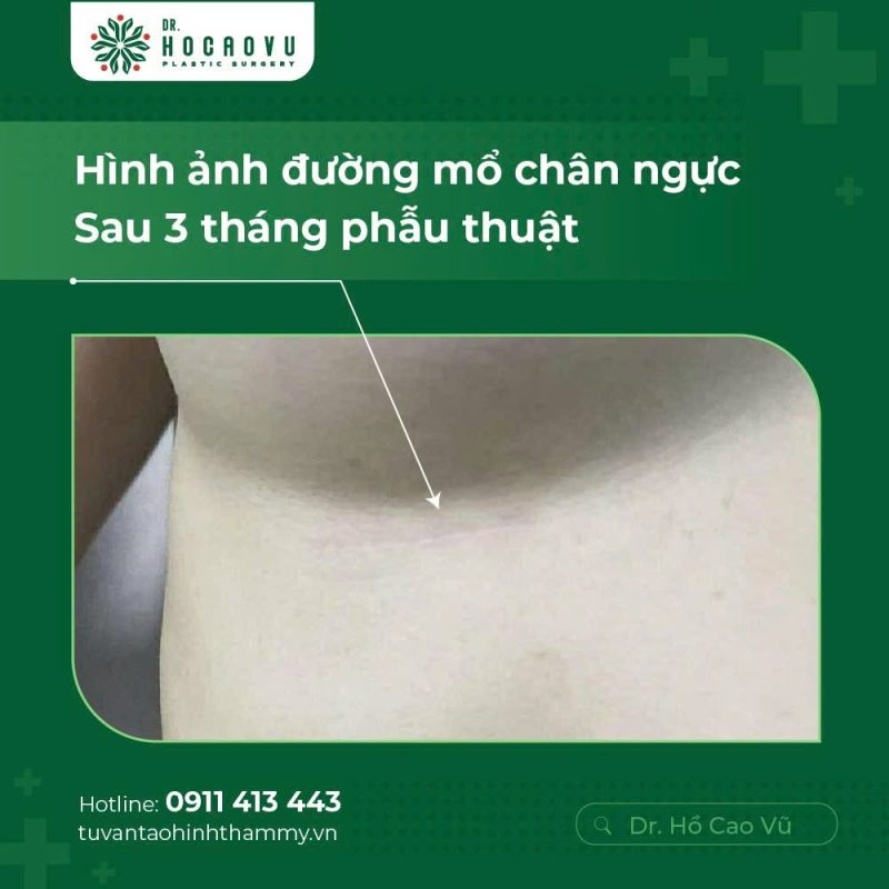 NÂNG NGỰC KHÔNG ĐAU - DAO SIÊU ÂM VÀ BƯỚC NHẢY VỌT CÔNG NGHỆ TRONG Y KHOA HIỆN ĐẠI
