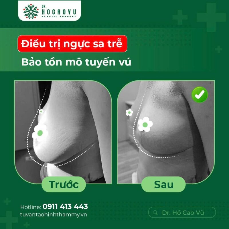 Mastopexy for sagging breasts