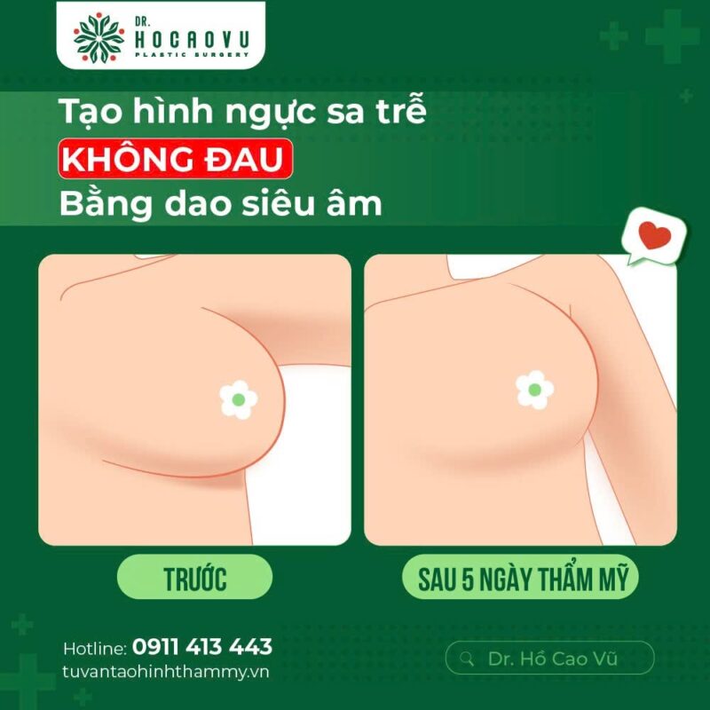 Mastopexy for sagging breasts