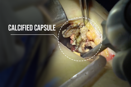 Capsulectomy of a calcified capsule 20 years after saline breast implant placement