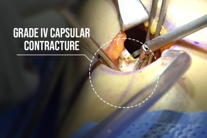 Grade IV capsulectomy 18 years after Nagor breast implant placement