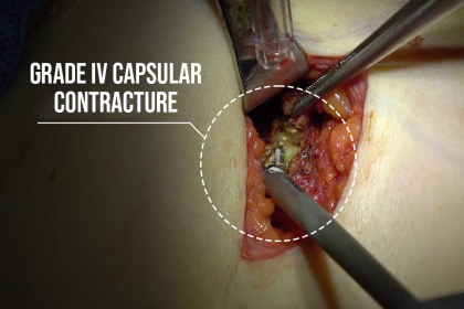 Grade IV capsulectomy 4 years after Polytech implant placement