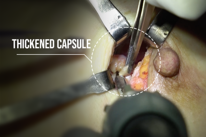 Capsulectomy of a thick fibrous capsule 10 years after breast implant placement