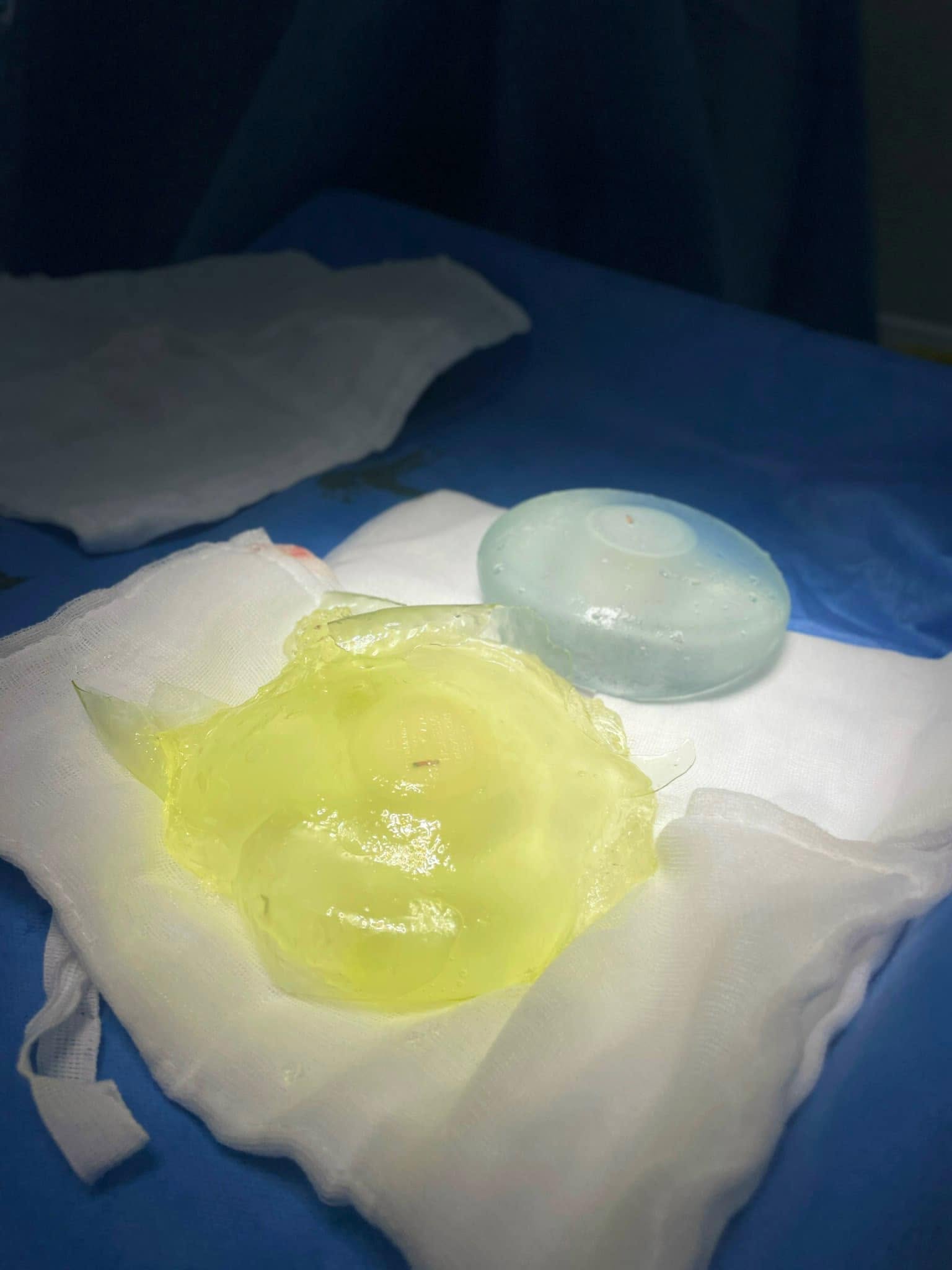 Causes of early breast implant rupture