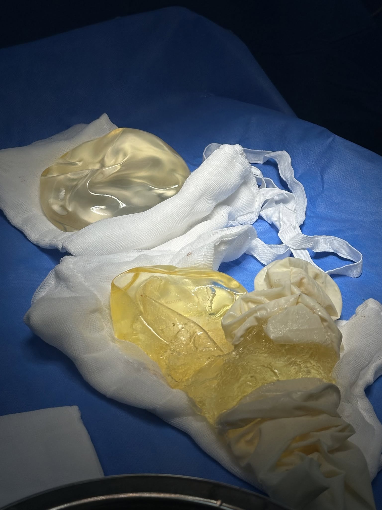 Causes of early breast implant rupture