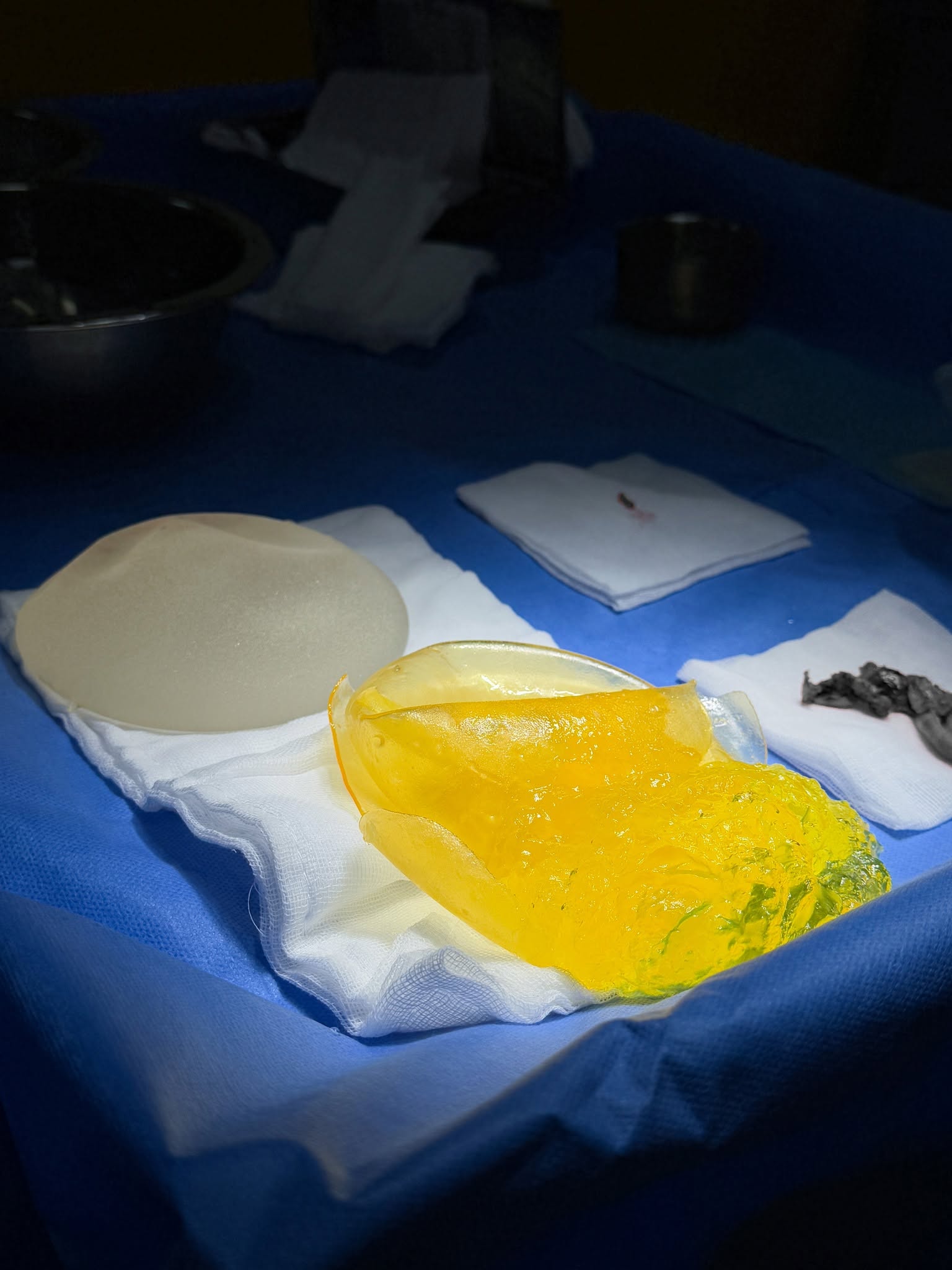 Causes of early breast implant rupture