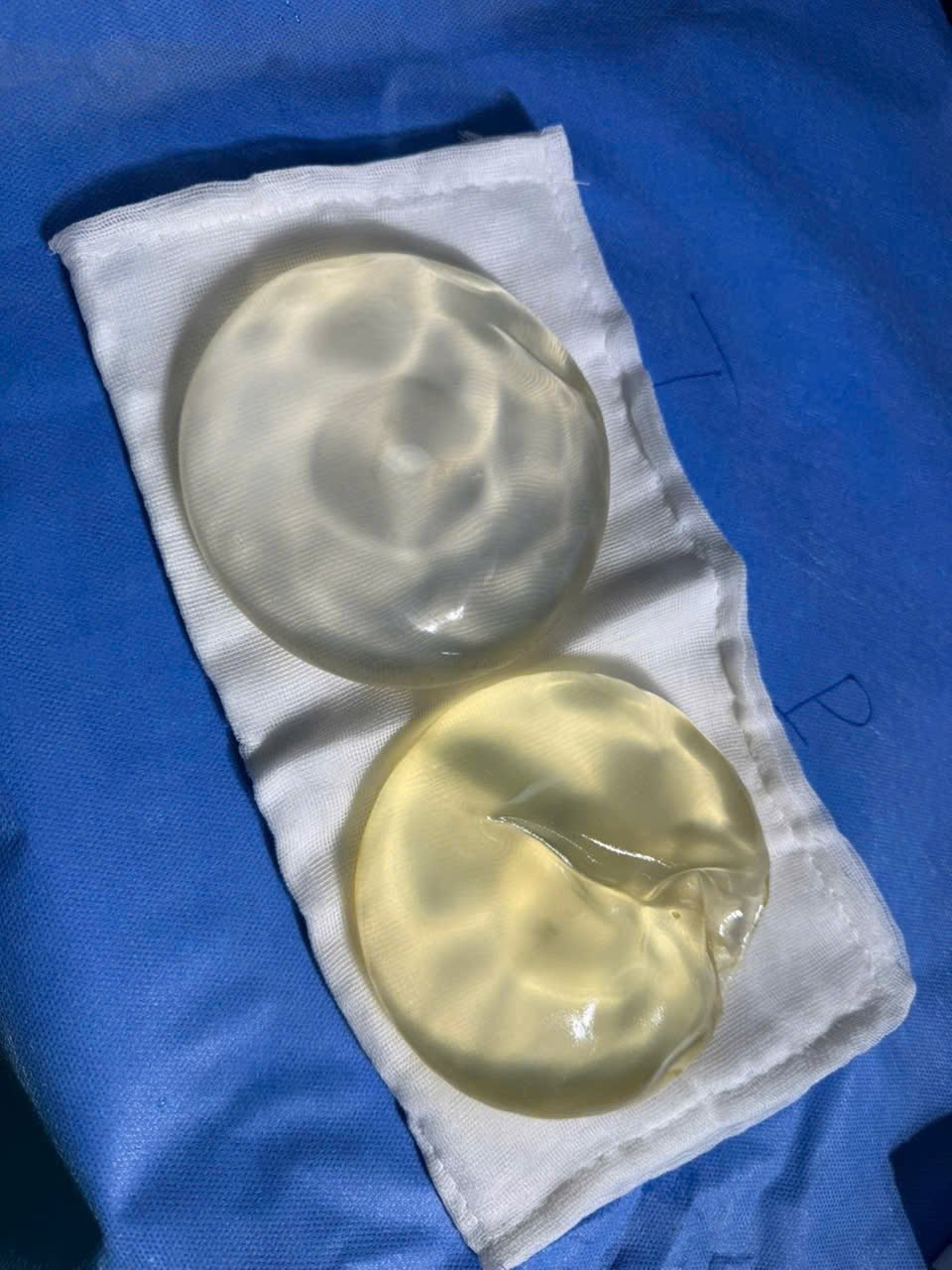 Causes of early breast implant rupture