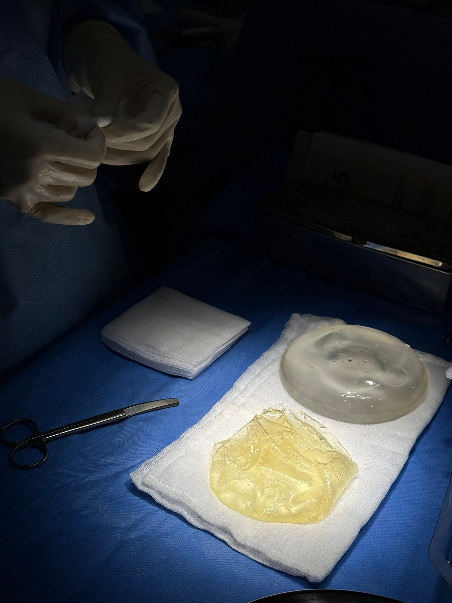Causes of early breast implant rupture