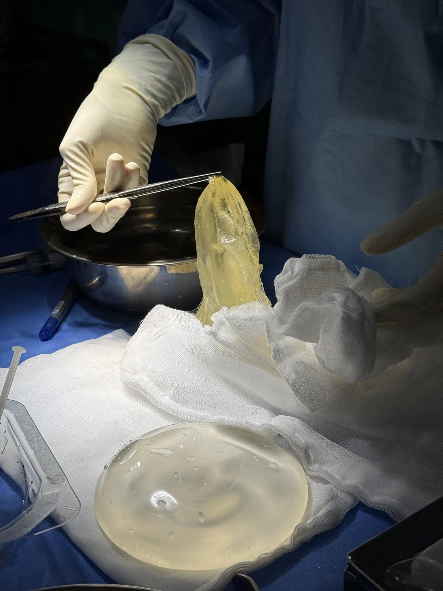 Causes of early breast implant rupture