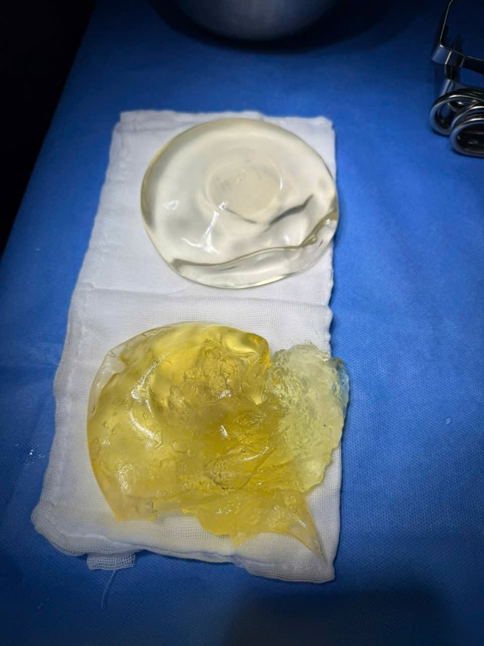 Causes of early breast implant rupture