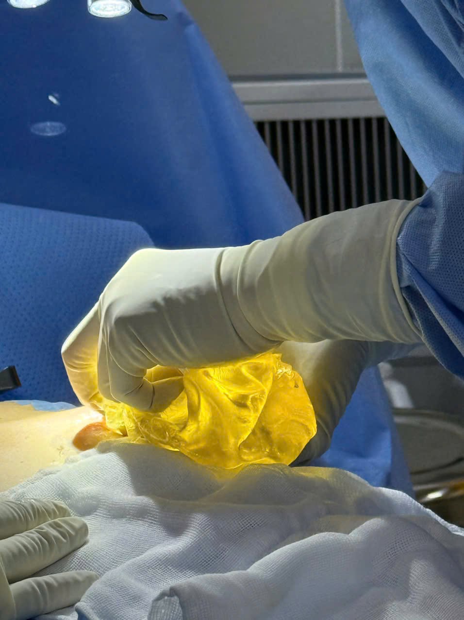 Causes of early breast implant rupture