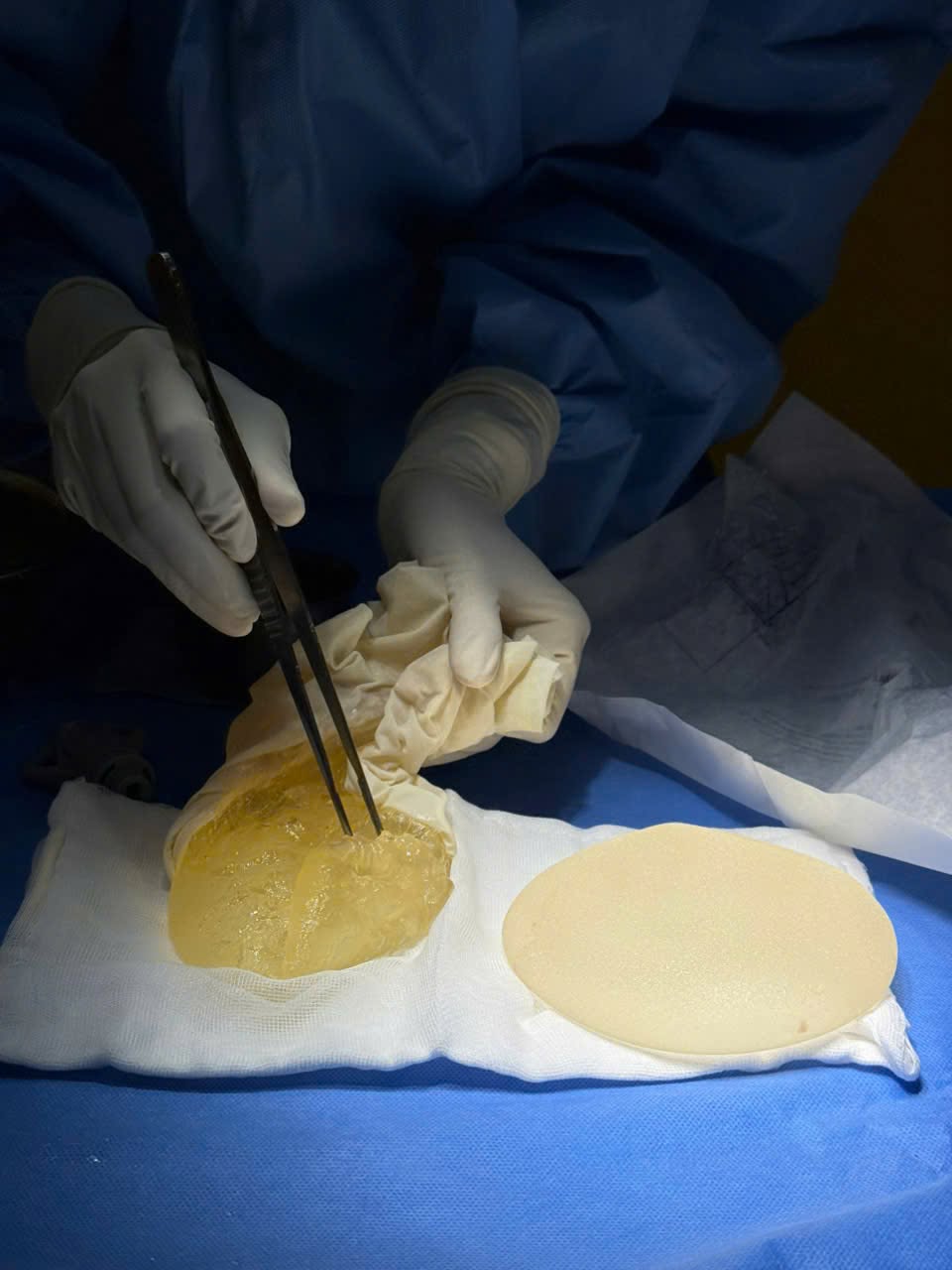 Causes of early breast implant rupture