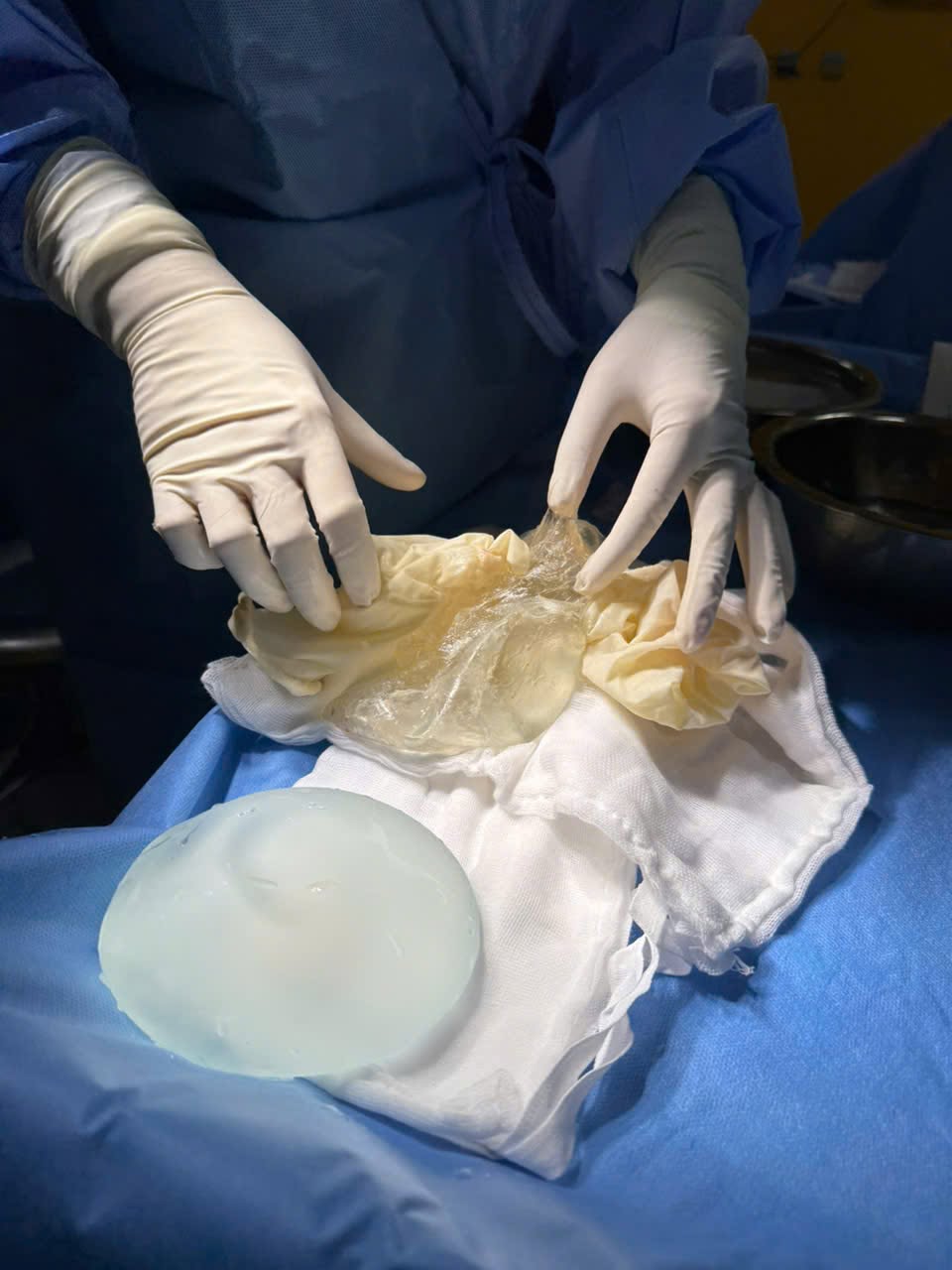 Causes of early breast implant rupture
