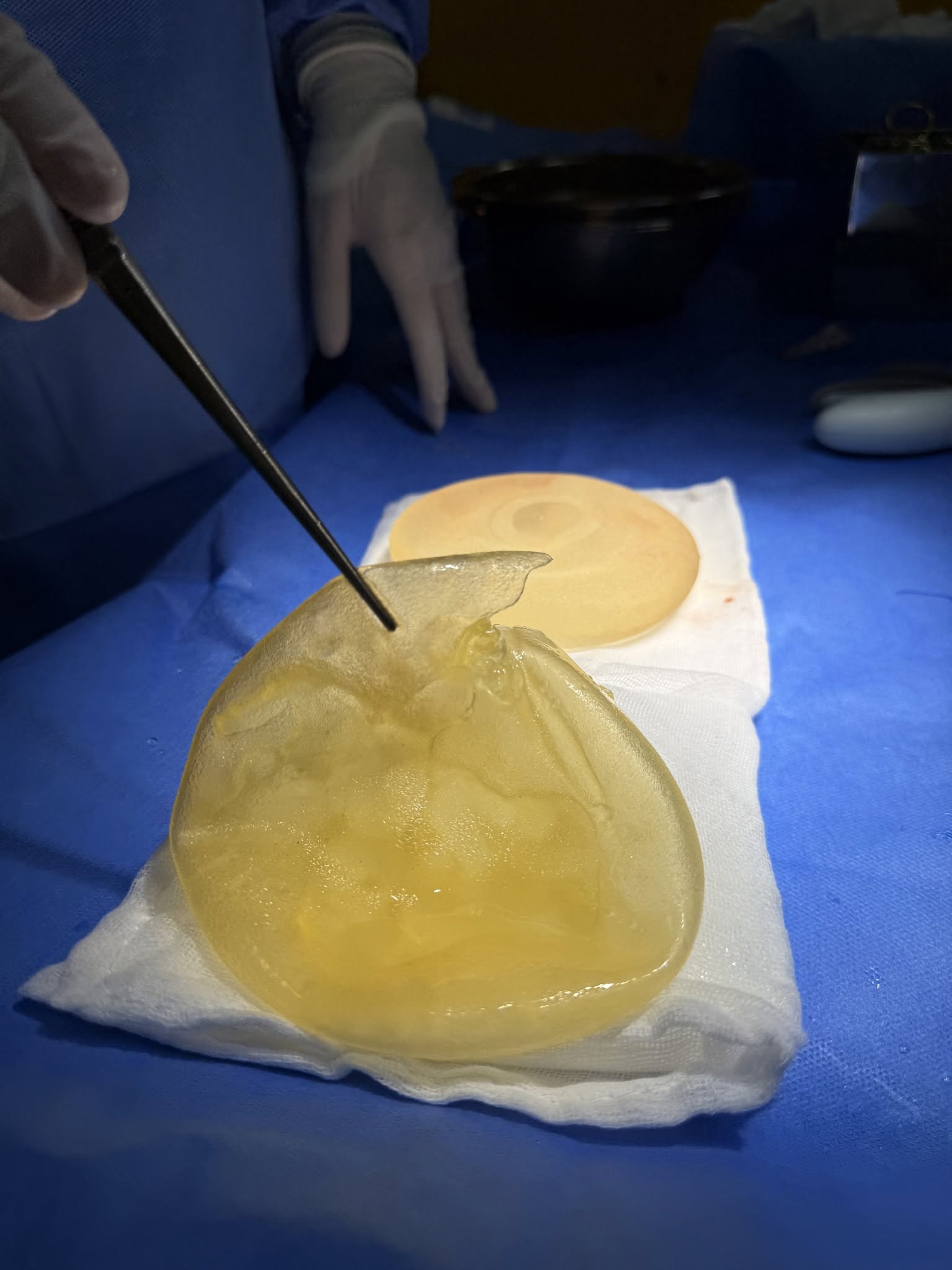 Causes of early breast implant rupture