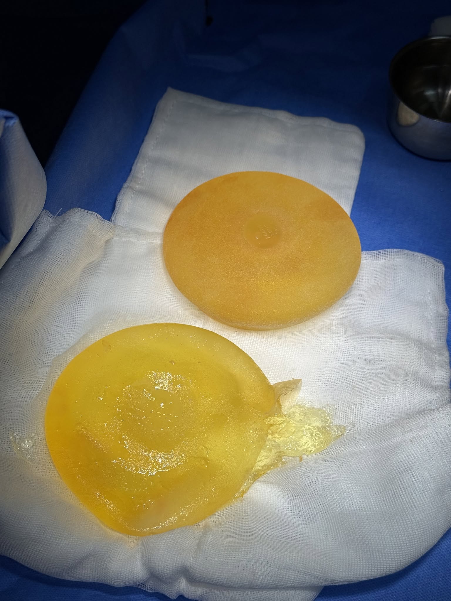 Causes of early breast implant rupture