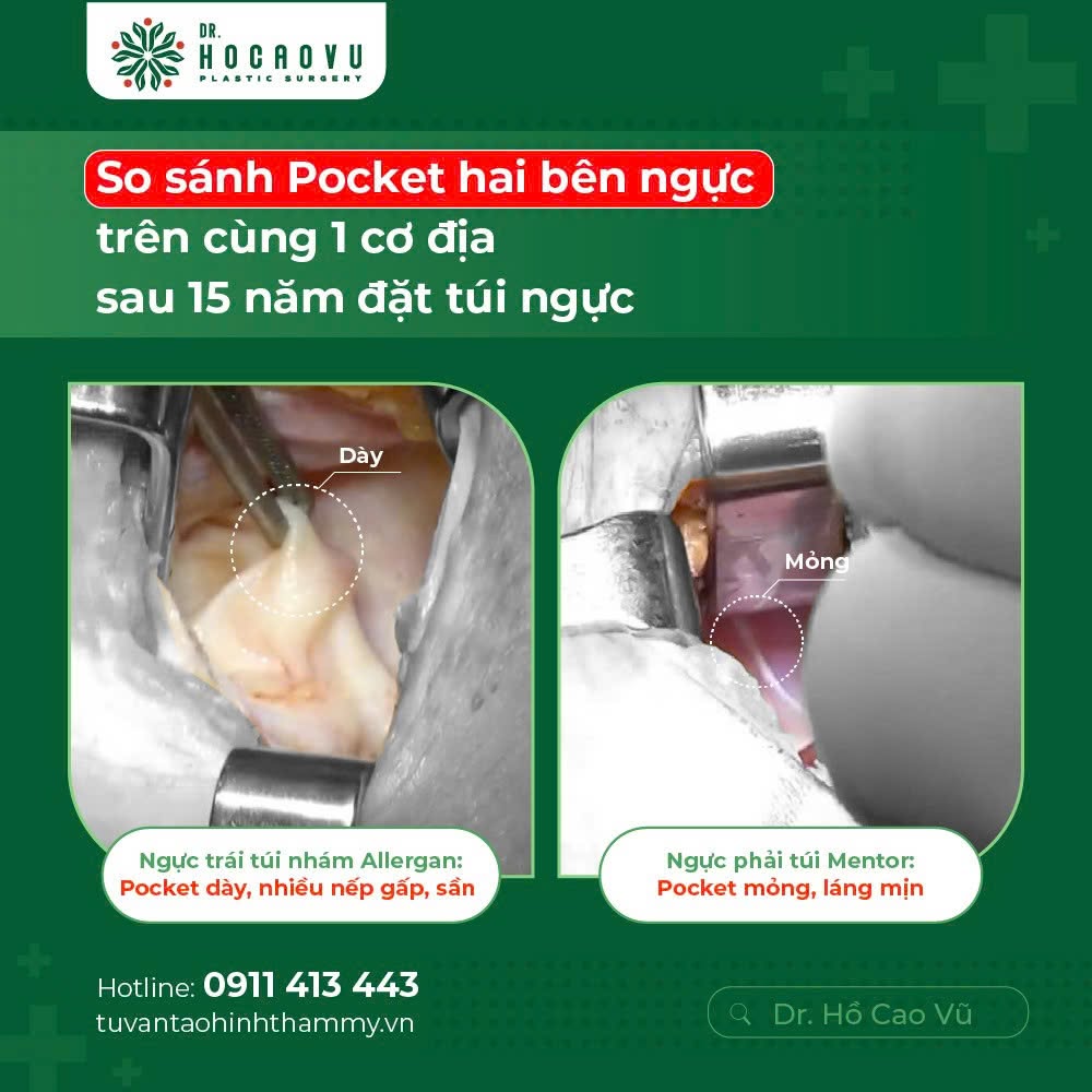 Differences between textured and smooth breast implants on the same body