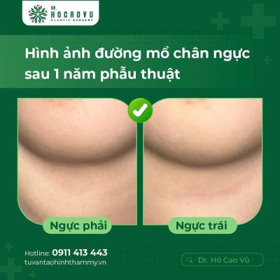 Breast Augmentation in Vietnam: A Guide for International Patients