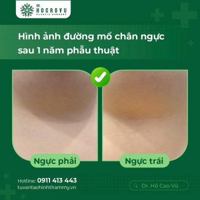 Breast Augmentation in Vietnam: A Guide for International Patients