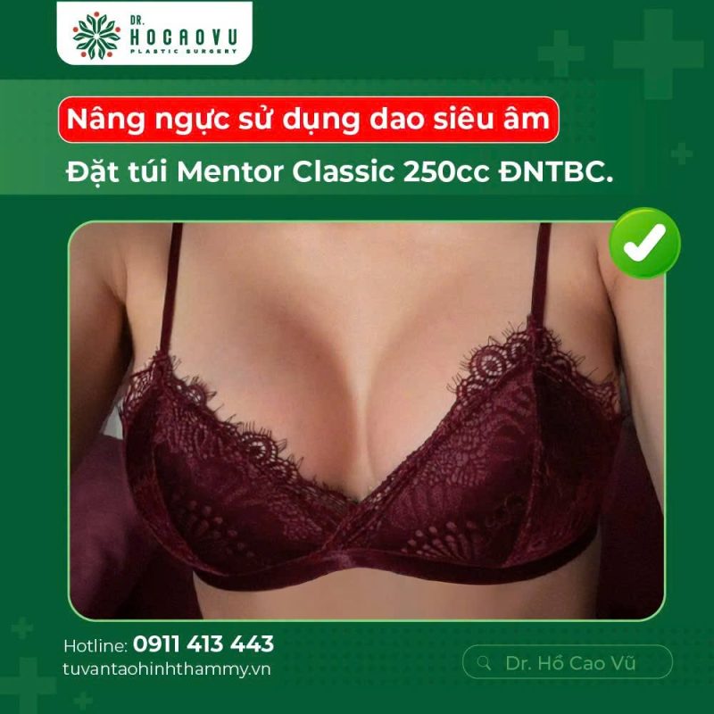 Breast Augmentation in Vietnam: A Guide for International Patients