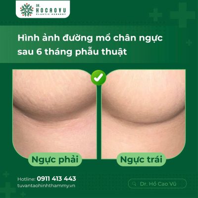 Breast Augmentation in Vietnam: A Guide for International Patients