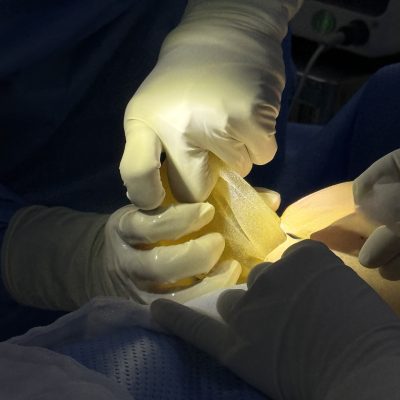 Differences between textured and smooth breast implants on the same body
