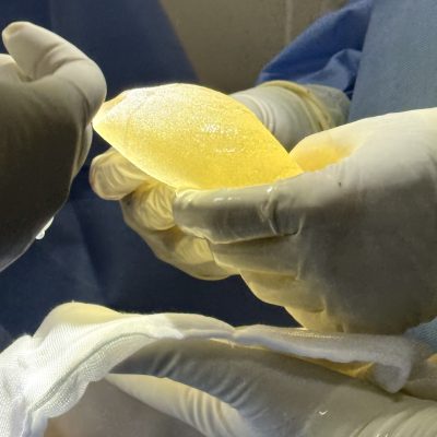 Differences between textured and smooth breast implants on the same body