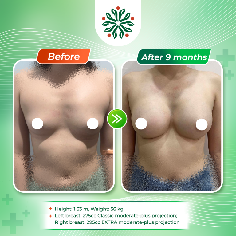 Breast Augmentation with Different Implant Sizes, 275 cc and 295 cc, for a Patient with Uneven Glandular Tissue Between Both Sides