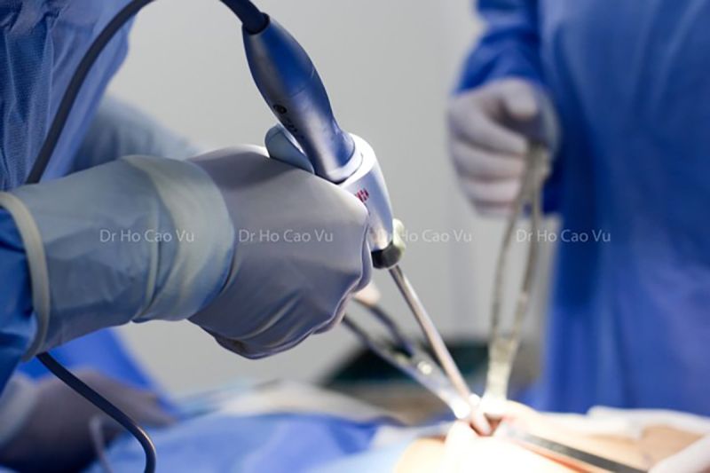 Breast Augmentation in Vietnam: A Guide for International Patients