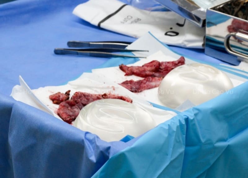 Capsular Contracture After Breast Augmentation