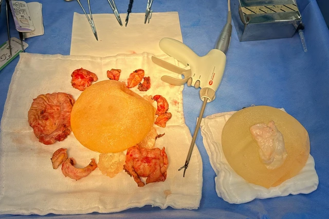 Capsular Contracture After Breast Augmentation