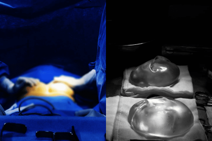 Capsular Contracture After Breast Augmentation