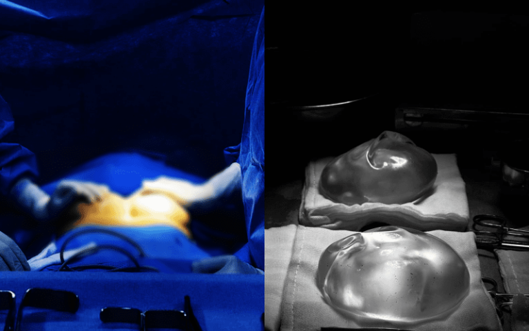 Capsular Contracture After Breast Augmentation